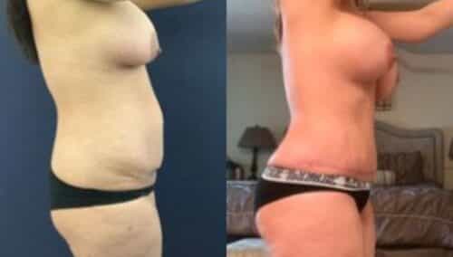 tummy tuck colombia 235-3-min