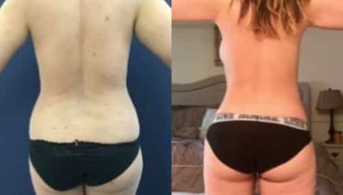 tummy tuck colombia 235-4-min