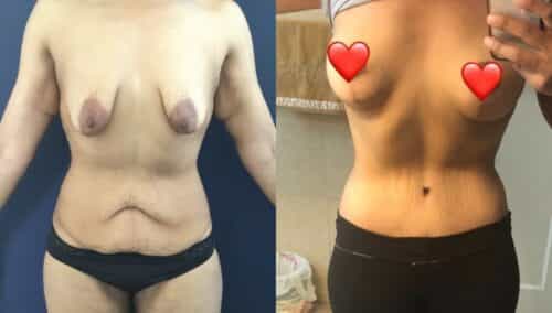 tummy tuck colombia 236-1-min