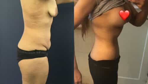 tummy tuck colombia 236-2-min