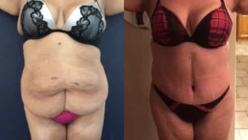 tummy tuck colombia 237-1-min