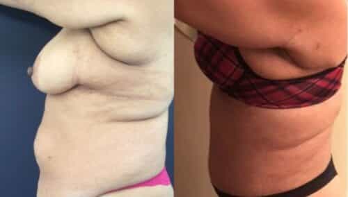 tummy tuck colombia 237-2-min