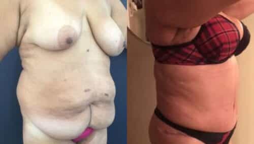 tummy tuck colombia 237-3-min