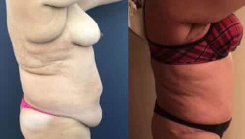 tummy tuck colombia 237-4-min