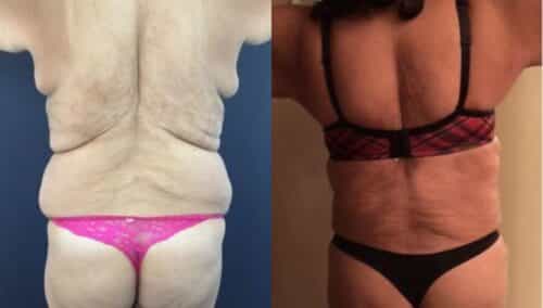 tummy tuck colombia 237-5-min