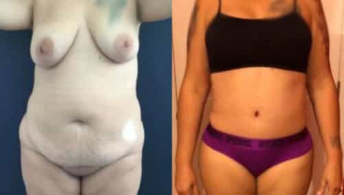 tummy tuck colombia 243-1-min