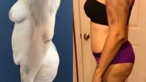 tummy tuck colombia 243-2-min