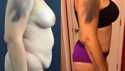 tummy tuck colombia 243-3-min
