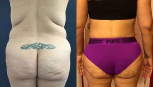 tummy tuck colombia 243-4-min