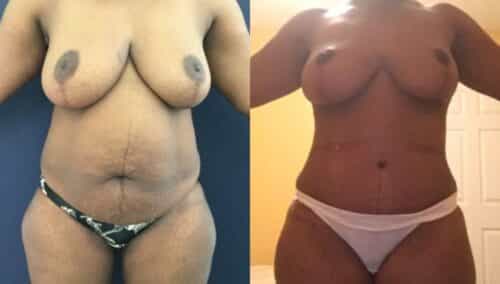 tummy tuck colombia 245-1-min
