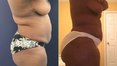 tummy tuck colombia 245-2-min