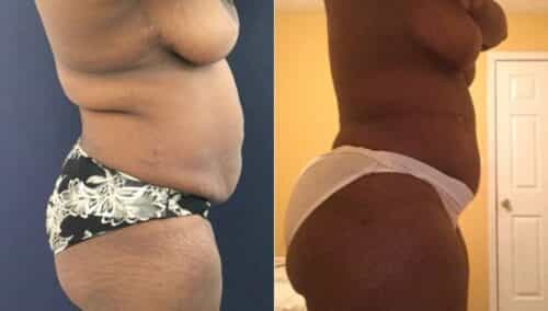 tummy tuck colombia 245-3-min