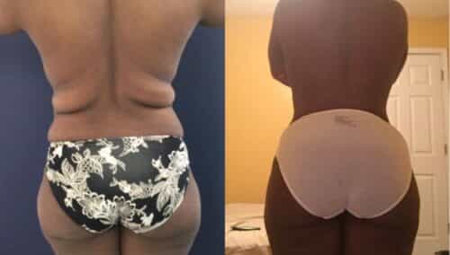 tummy tuck colombia 245-4-min