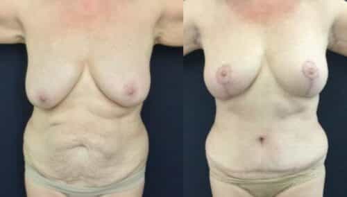 tummy tuck colombia 246-1-min