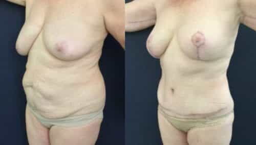 tummy tuck colombia 246-2-min
