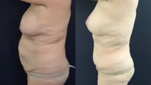 tummy tuck colombia 246-3-min