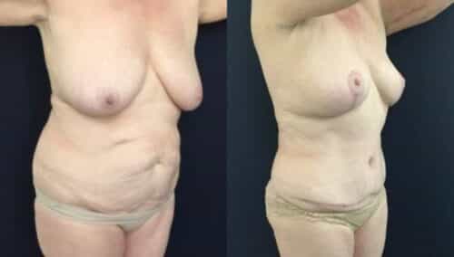 tummy tuck colombia 246-4-min