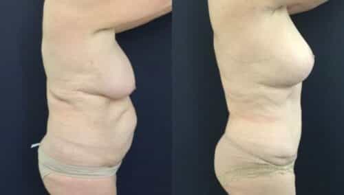 tummy tuck colombia 246-5-min