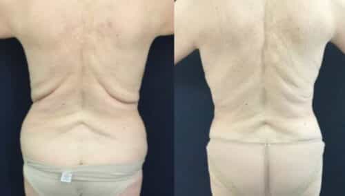 tummy tuck colombia 246-6-min