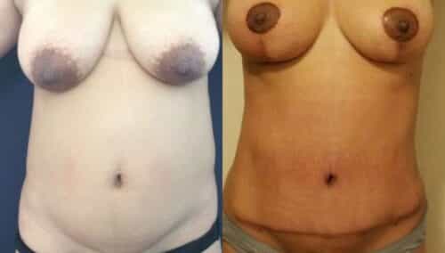 tummy tuck colombia 247-1-min