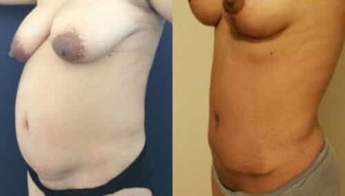 tummy tuck colombia 247-2-min