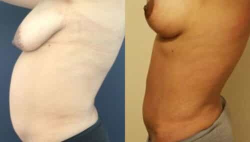 tummy tuck colombia 247-3-min