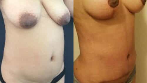 tummy tuck colombia 247-4-min