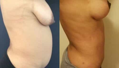 tummy tuck colombia 247-5-min