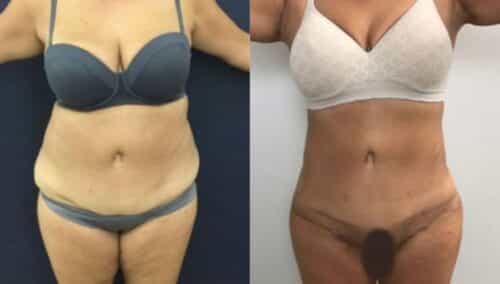 tummy tuck colombia 248-1-min
