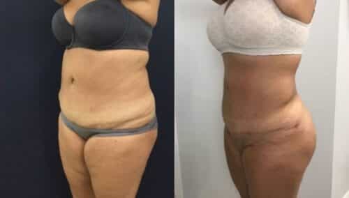 tummy tuck colombia 248-2-min