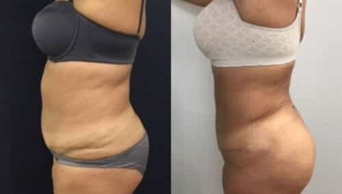 tummy tuck colombia 248-3-min