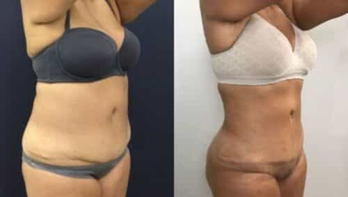 tummy tuck colombia 248-4-min