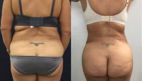 tummy tuck colombia 248-6-min