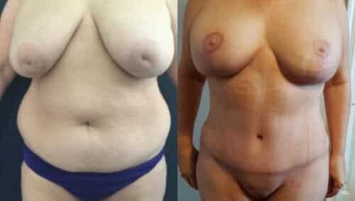 tummy tuck colombia 252-1-min