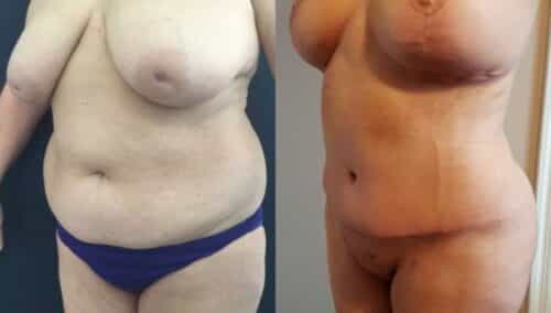 tummy tuck colombia 252-2-min