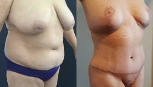 tummy tuck colombia 252-3-min