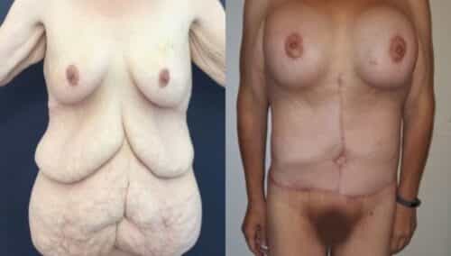 tummy tuck colombia 253-1-min
