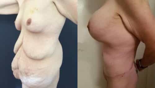 tummy tuck colombia 253-2-min