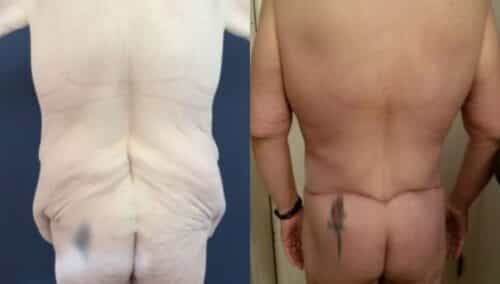tummy tuck colombia 253-3-min