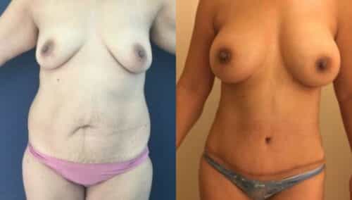 tummy tuck colombia 254-1-min