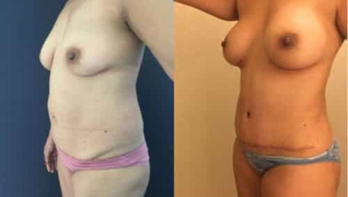 tummy tuck colombia 254-2-min