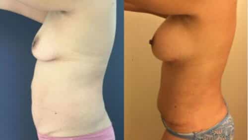 tummy tuck colombia 254-3-min