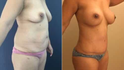 tummy tuck colombia 254-4-min