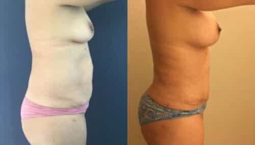tummy tuck colombia 254-5-min