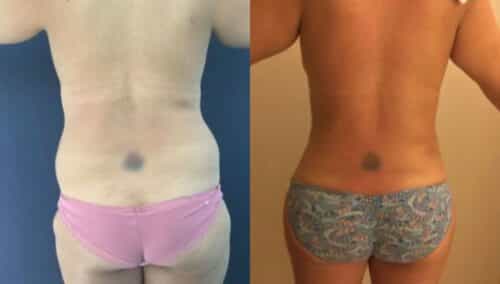 tummy tuck colombia 254-6-min