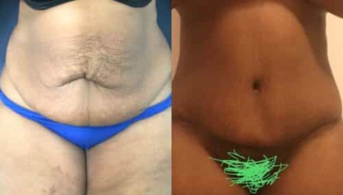tummy tuck colombia 255-1-min