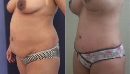 tummy tuck colombia 257-2-min