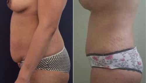 tummy tuck colombia 257-3-min