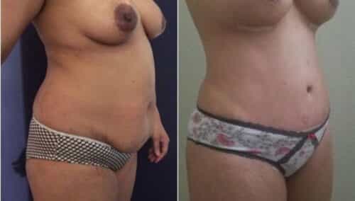 tummy tuck colombia 257-4-min