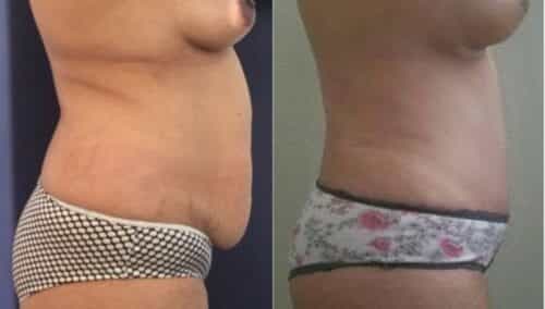 tummy tuck colombia 257-5-min
